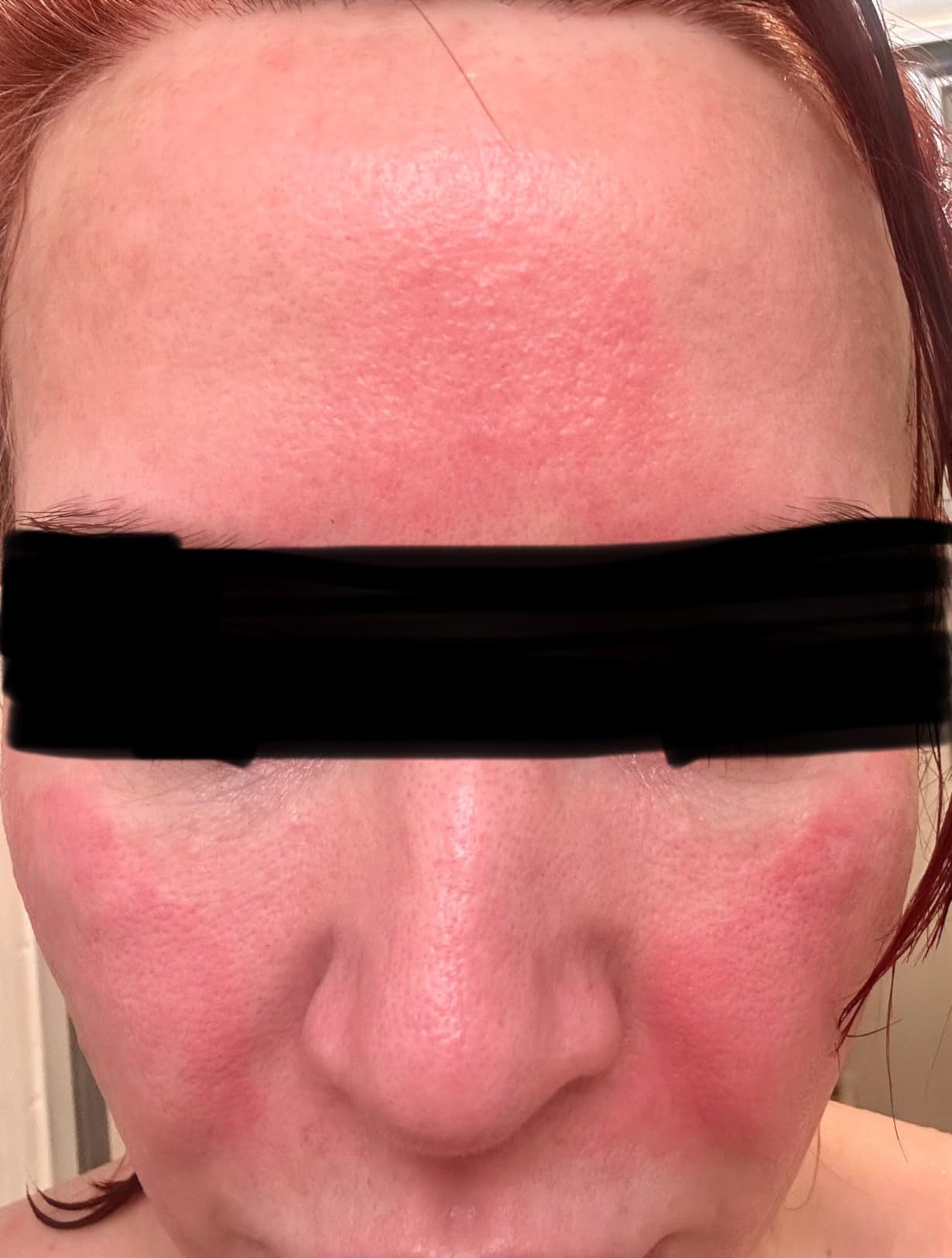 HigherDOSE Red Light Face Mask - FDA Cleared LED Red Light Therapy for Face with Near Infrared Technology - At-Home Facial Device to Improve Fine Lines, Wrinkles, Hydration & Redness for Glass Skin - Customer Photo 2