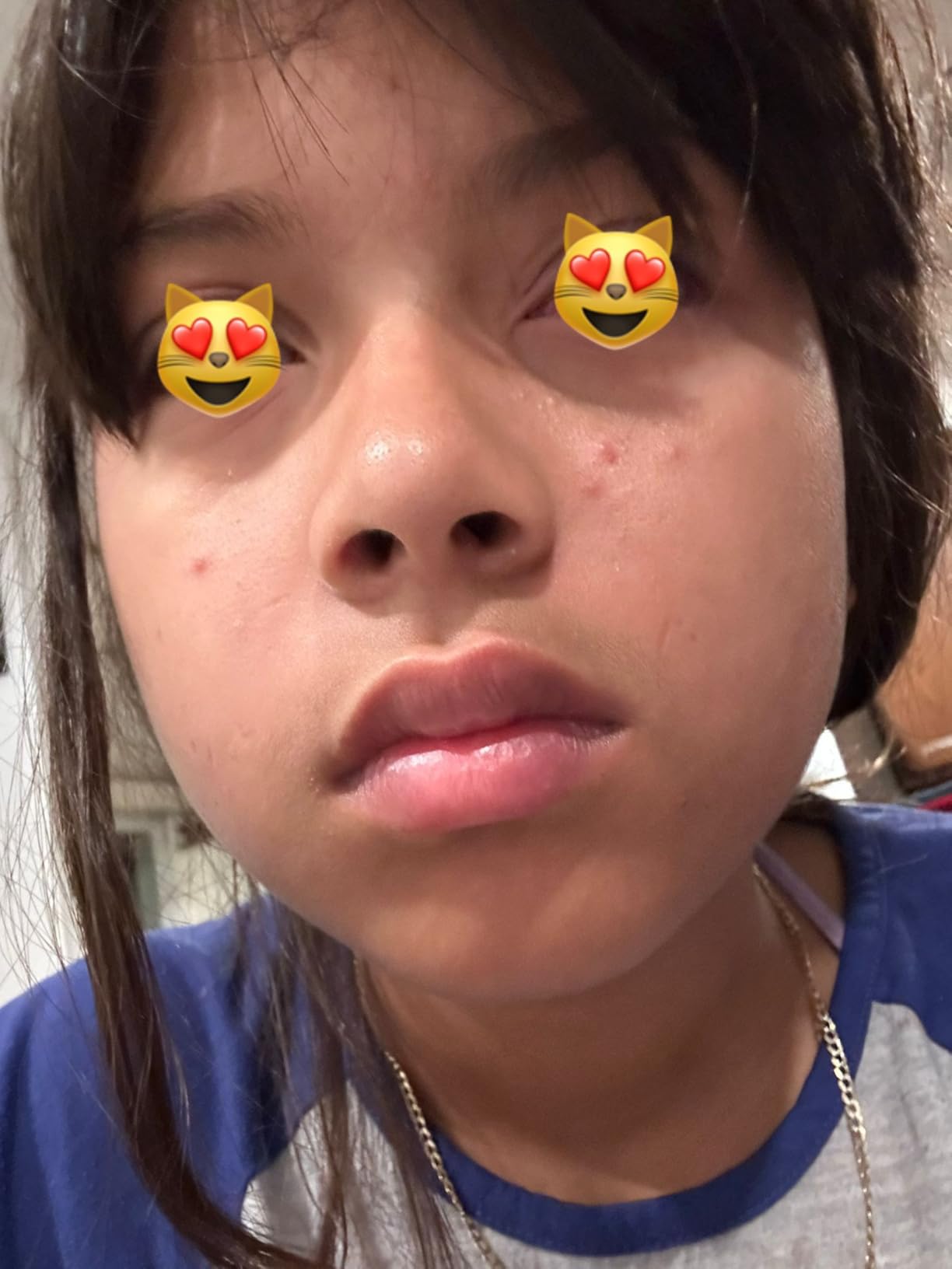 The Ordinary The Acne Set, 3-Step Skin Regimen with Glucoside Foaming Cleanser, Salicylic Acid 2% Solution, and Natural Moisturizing Factors + Beta Glucan | Skin Care Set - Customer Photo 2